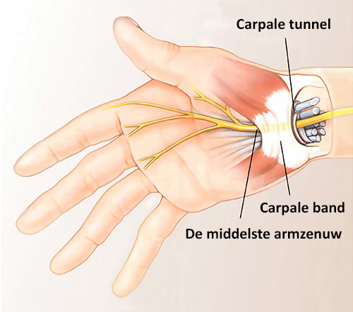 cassette toediening perspectief neurospine: Carpaal tunnelsyndroom (CTS)