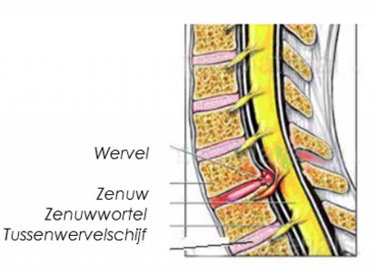 Neurospine: Nekhernia